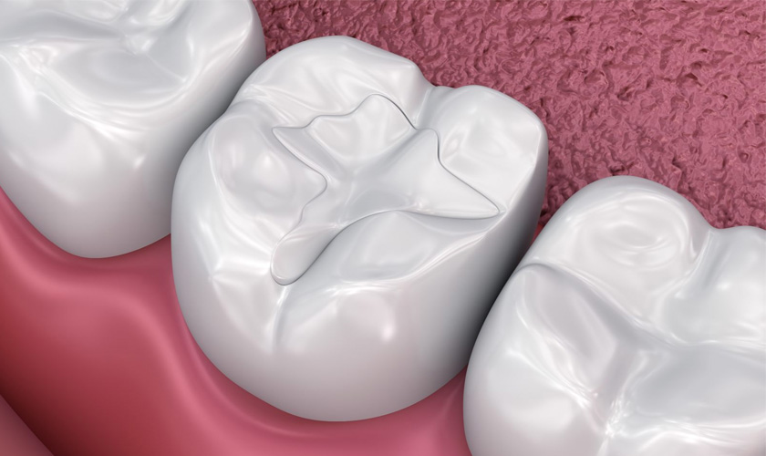 Trám răng là phương pháp phục hồi và thẩm mỹ răng đơn giản, tiết kiệm được nhiều người ưa chuộng