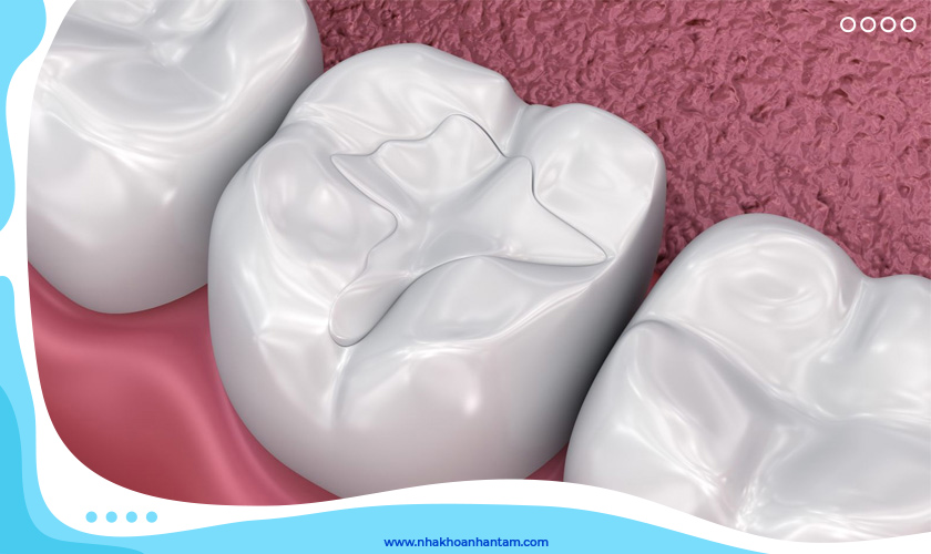 Trám răng bằng vật liệu composite ngày càng được ưa chuộng vì tính thẩm mỹ cao