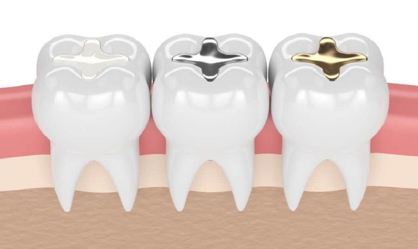 Chi phí trám răng thay đổi theo chất liệu trám sử dụng