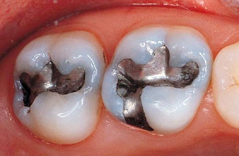 Sử dụng chất liệu Amalgam để trám răng