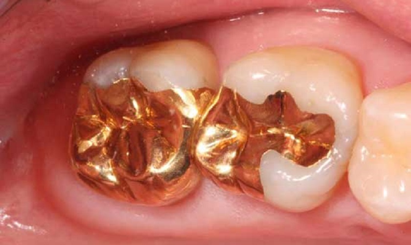 Trám răng bằng vàng