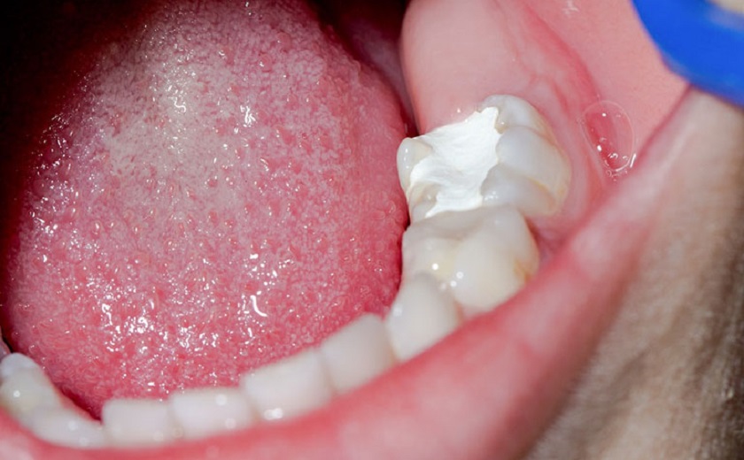 Trám răng bằng chất liệu GIC