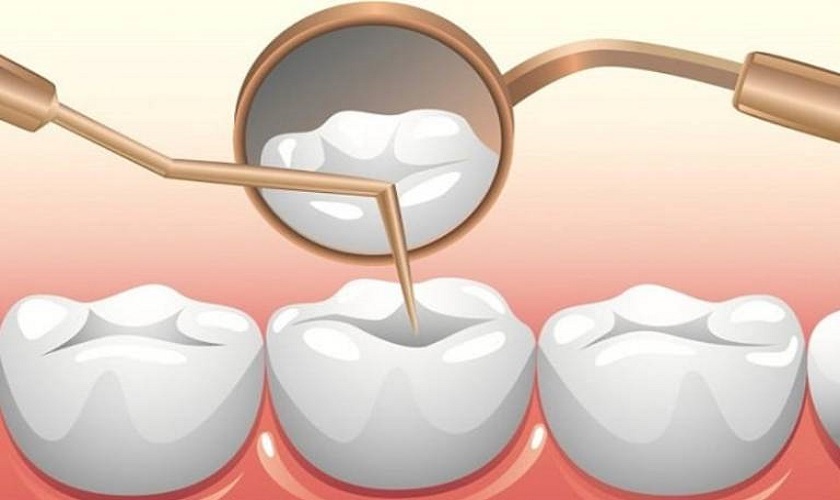 Trám răng: Chi phí, vật liệu, quy trình & câu hỏi thường gặp