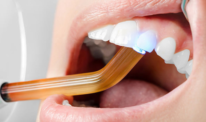 Trám răng công nghệ Laser Tech Trám răng công nghệ Laser Tech