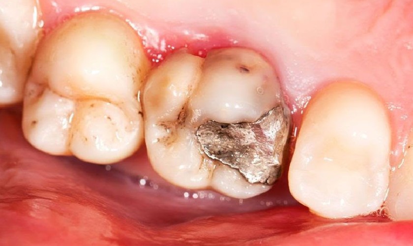 Trám răng Amalgam có thể dẫn nhiệt gây ê buốt khi ăn đồ quá nóng hay quá lạnh