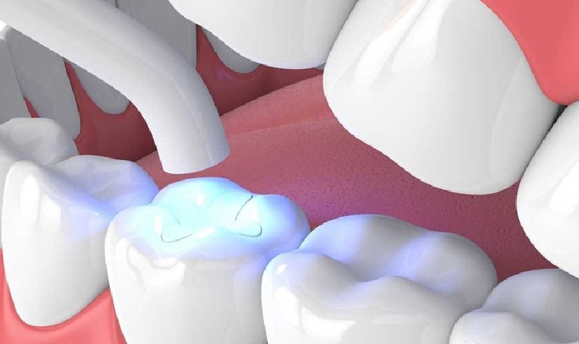 Vật liệu trám răng Composite được ưu tiên lựa chọn