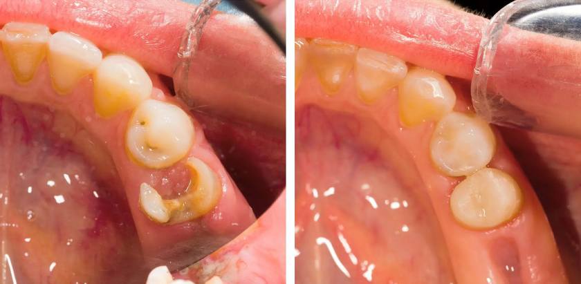 Trám răng thẩm mỹ Composite