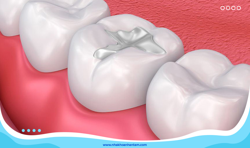 Amalgam có màu giống như mảnh bạc