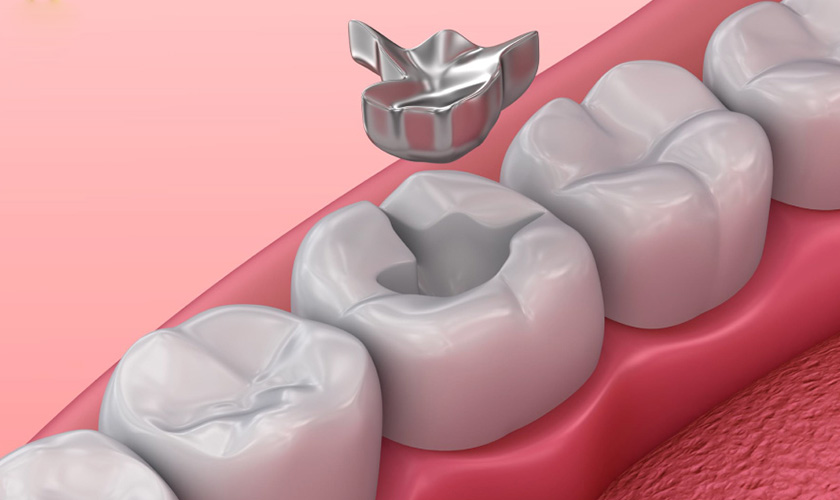 Trám Amalgam không mang lại thẩm mỹ cao