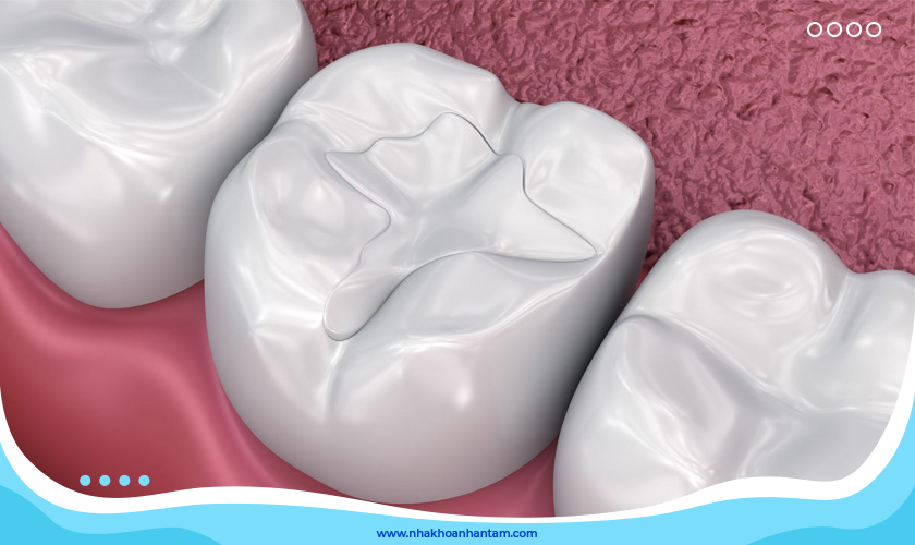 Composite là vật liệu được ưa chuộng nhất hiện nay trong kỹ thuật trám răng thẩm mỹ