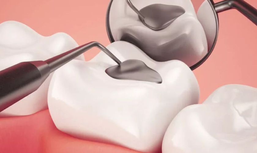 Trám răng Amalgam giúp khôi phục hình thể của răng