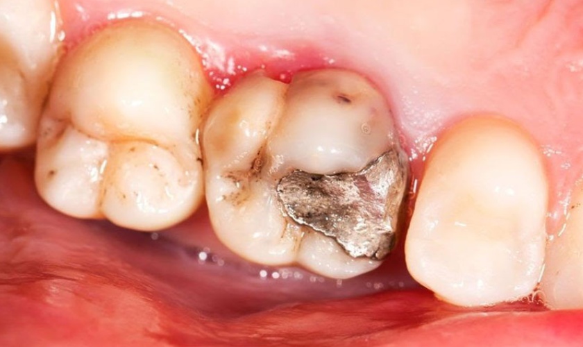 Vật liệu Amalgam có tính thẩm mỹ không cao