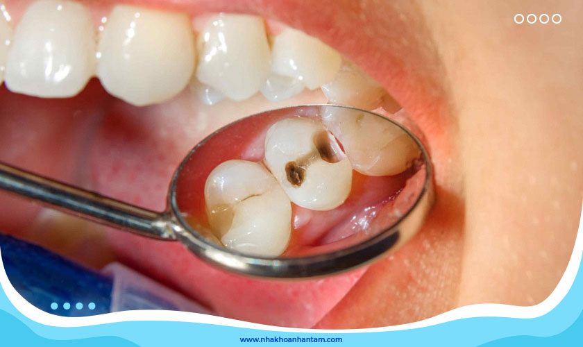 Sâu răng không chỉ phá hủy cấu trúc răng mà còn gây đau nhức, khó chịu