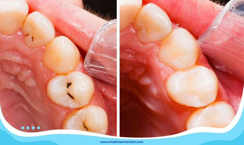Trám răng giúp khắc phục tình trạng sâu răng hiệu quả