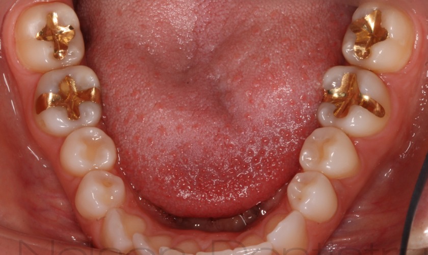 Trám răng bằng vàng khá cứng chắc