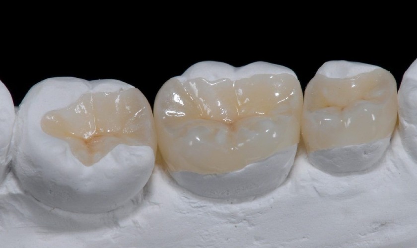 Trám răng Inlay - Onlay
