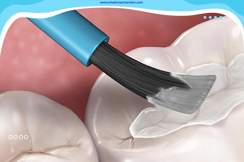 Những trường hợp sâu nhẹ thì trám răng không cần chích thuốc tê