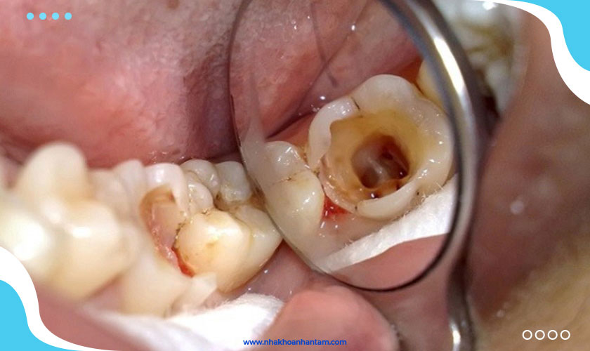 Răng sâu nặng thường không tránh khỏi trường hợp phải lấy tủy