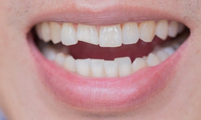 Trám răng cửa bị gãy vỡ nhẹ