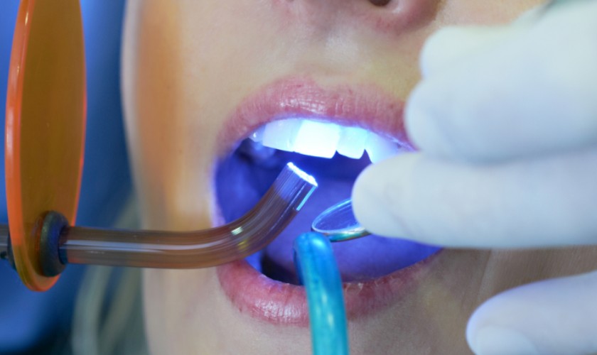 Trám răng là kỹ thuật nha khoa đơn giản, không gây đau nhức