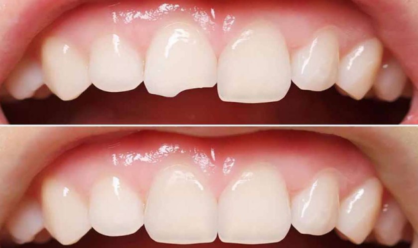 Trám răng cửa có bền không phụ thuộc vào rất nhiều yếu tố