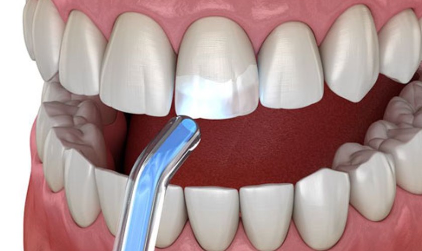 Giá trám răng cửa còn tùy thuộc vào vật liệu sử dụng