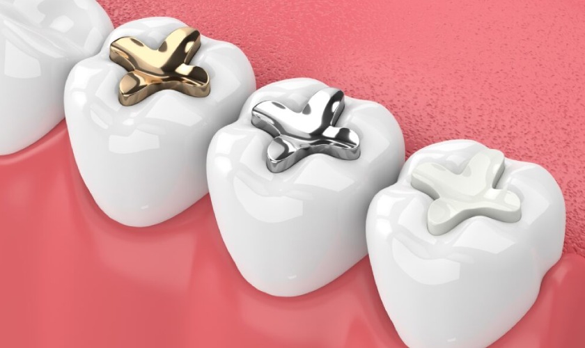 Trám răng dùng được bao lâu tùy vào vật liệu trám