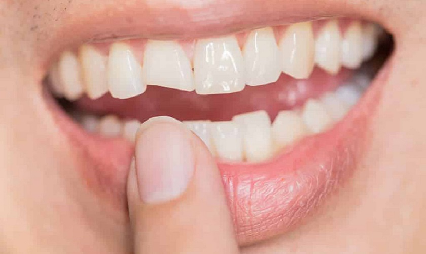 Răng bị gãy ảnh hưởng đến ăn nhai và thẩm mỹ