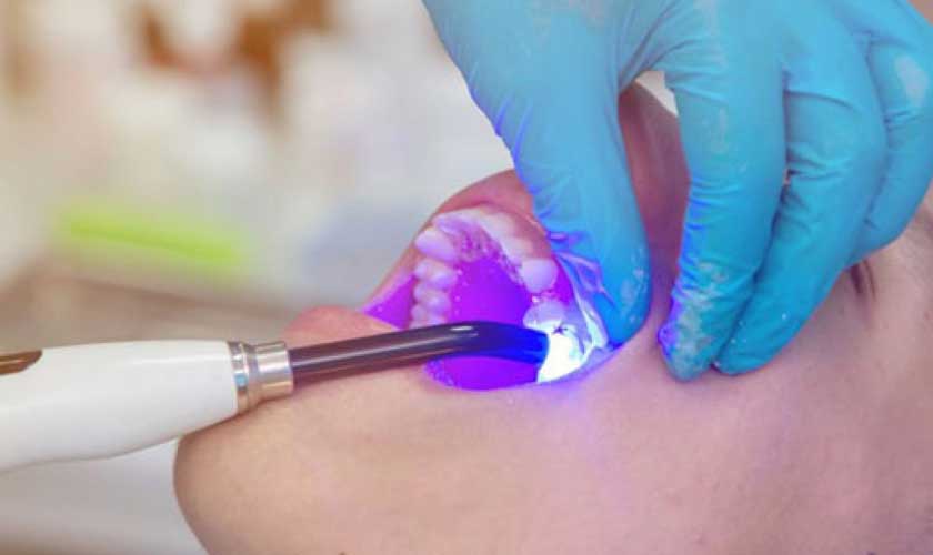 Trám răng Laser Tech 