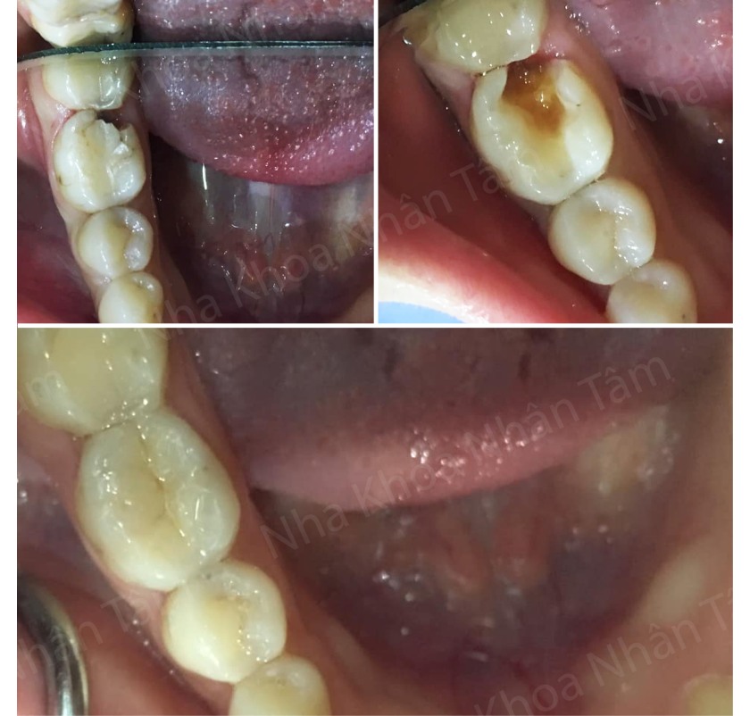 Trám răng tại Nha khoa Nhân Tâm