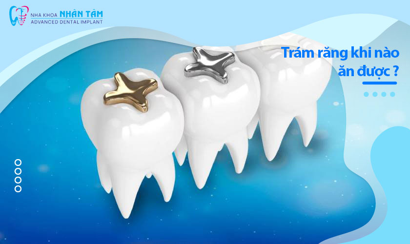 Trám răng khi nào ăn được? Lưu ý sau khi trám răng     
