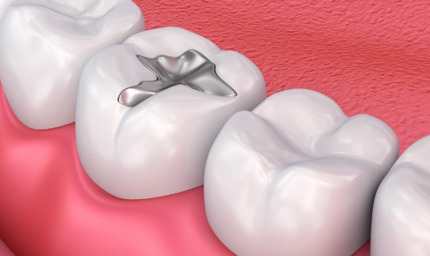 Trám răng bằng Amalgam