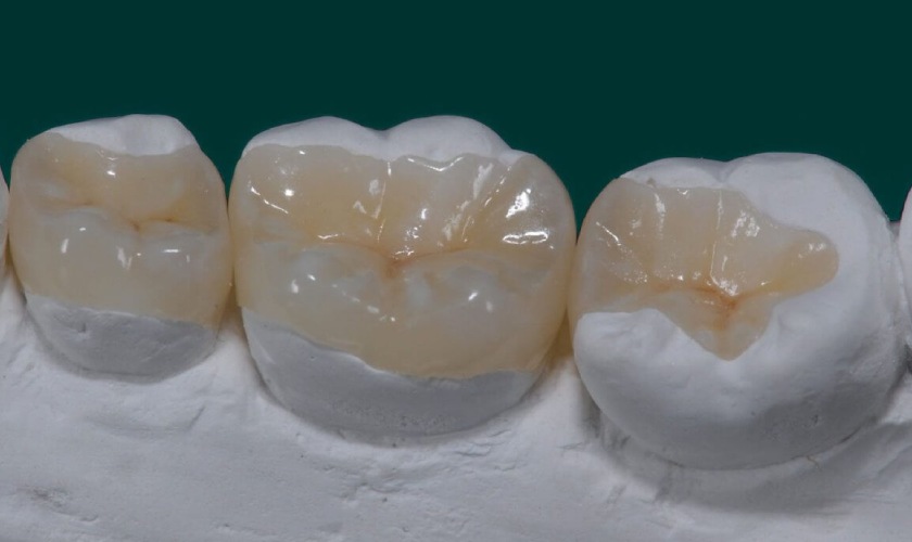 Trám răng Inlay - Onlay