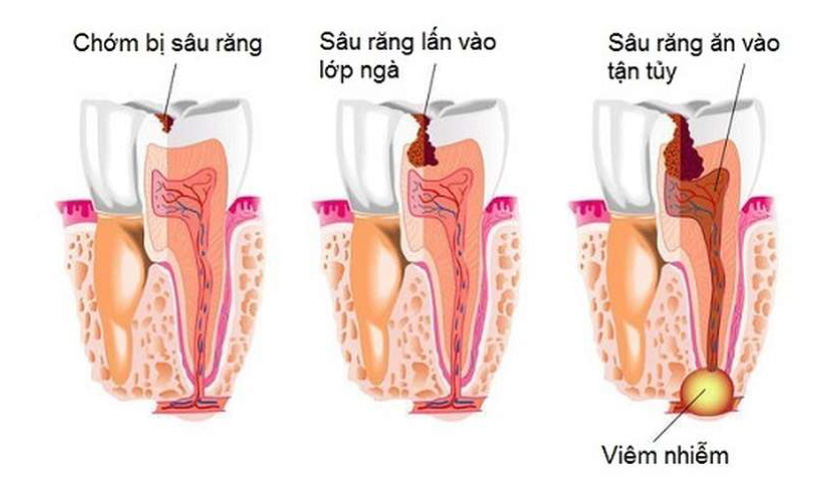 Nếu tủy bị viêm thì cần phải thực hiện điều trị tủy