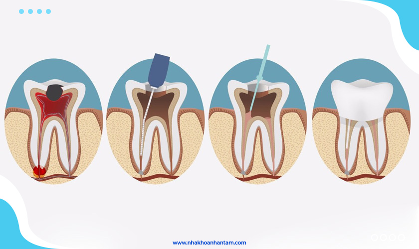 Tủy răng bị viêm nhiễm cần được lấy sạch để tránh làm hỏng răng