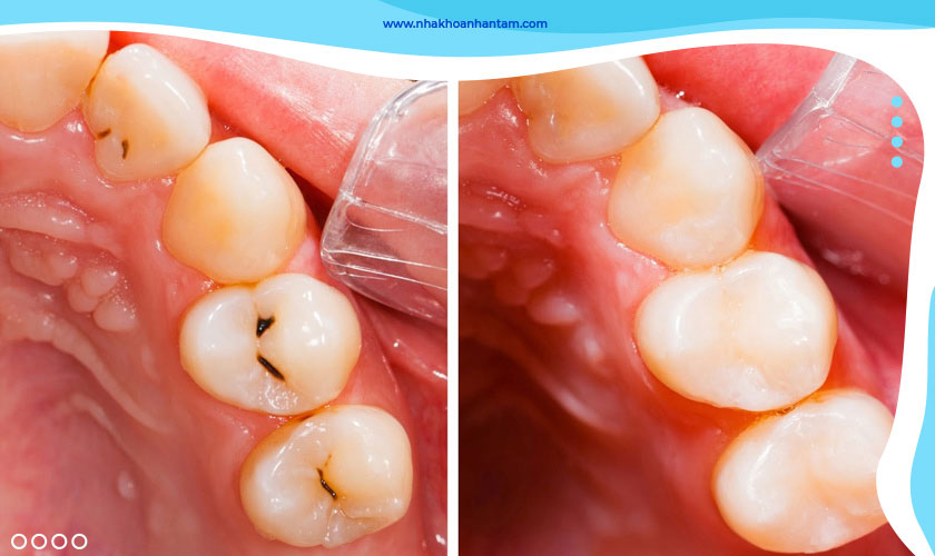 Trám răng giúp khắc phục tình trạng sâu răng hiệu quả