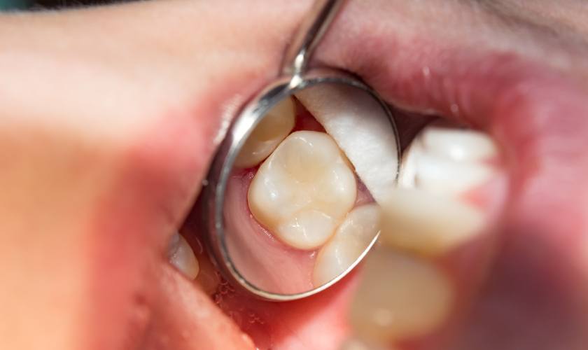 Trám răng được áp dụng trong trường hợp răng có lỗ hổng nhỏ để phục hồi hình dáng và thẩm mỹ cho răng