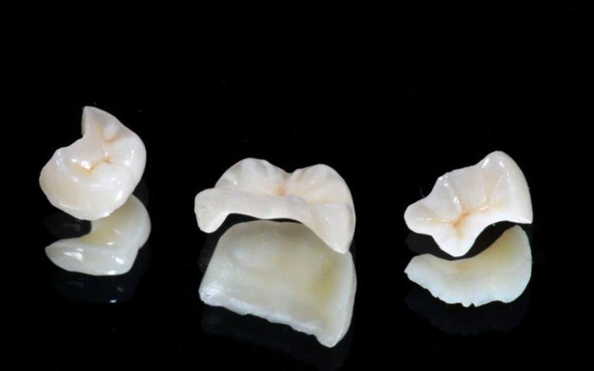 Miếng trám bằng sứ