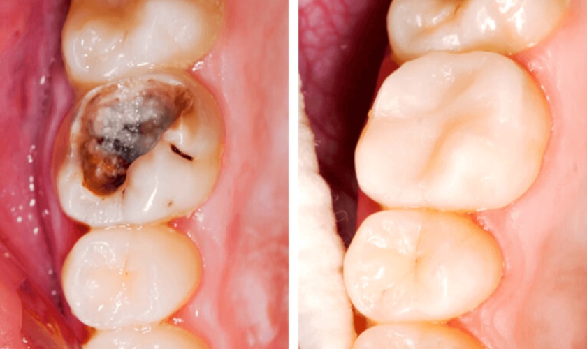 Trám răng sâu lỗ to bao nhiêu tiền còn tùy thuộc vào loại vật liệu trám