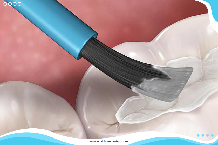 Trám răng thẩm mỹ có nhiều ưu điểm vượt trội