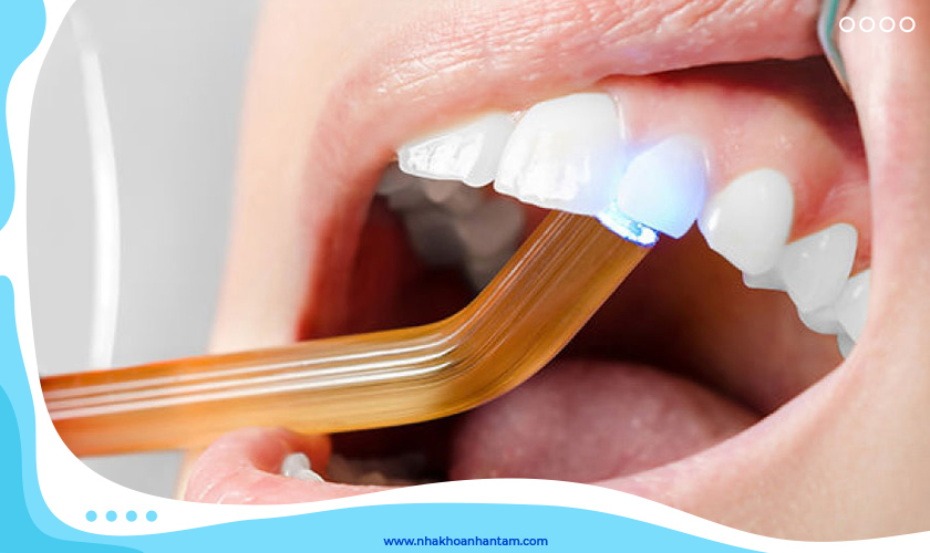 Phương pháp trám răng composite được ưa chuộng nhất hiện nay