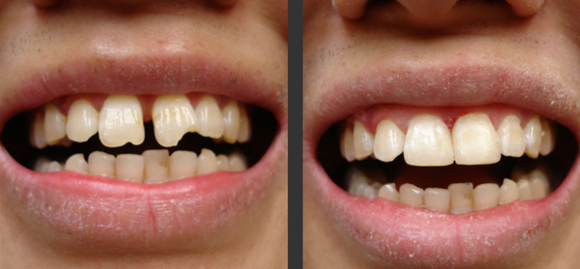 Trám răng giúp khắc phục tình trạng răng thưa hiệu quả