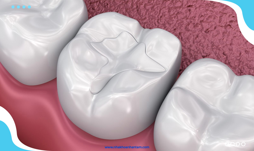 Trám răng thẩm mỹ là phương pháp giúp bảo vệ và phòng ngừa sâu răng hiệu quả