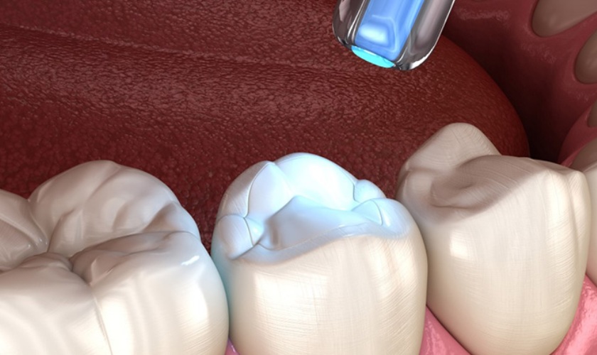 Trám răng xong bị ê buốt do nhiều nguyên nhân gây nên