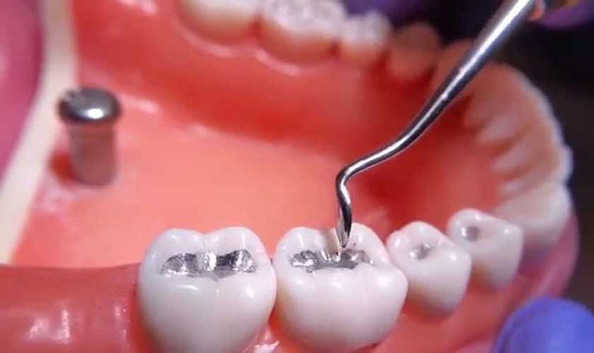 Trám răng amalgam không được đánh giá cao về thẩm mỹ