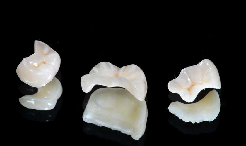 Phục hình sứ inlay - onlay