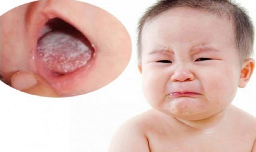 Biểu hiện khi trẻ bị cam ở miệng