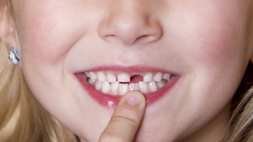 Có nên nhổ khi răng sữa lung lay? Bao lâu thì nên nhổ?