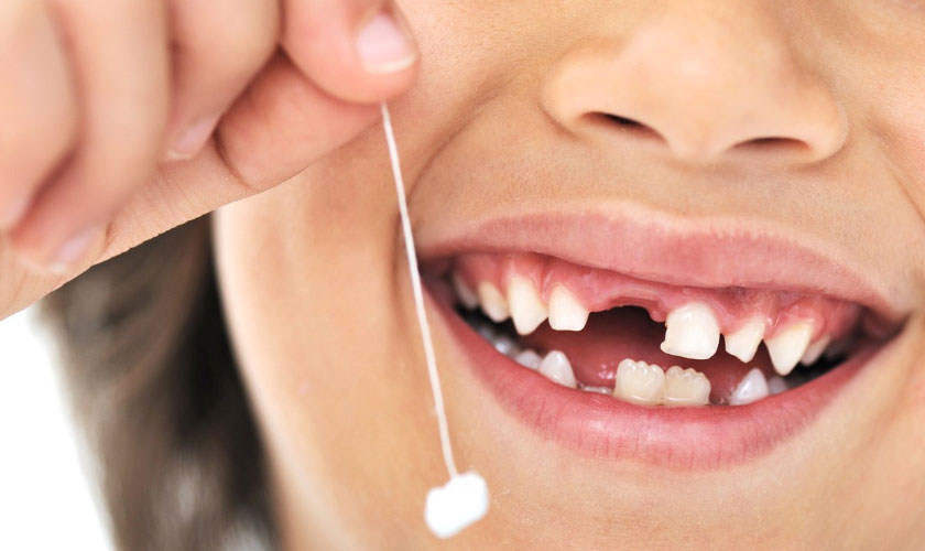 Nhổ răng sữa đúng thời điểm đảm bảo răng vĩnh viễn mọc đúng vị trí