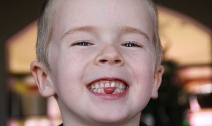 Đẩy lưỡi tưởng chừng như vô hại ở một số trẻ nhỏ là tác nhân gây hô răng